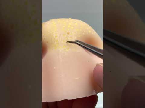 Blackhead Pimple Popping Toy - Bignose